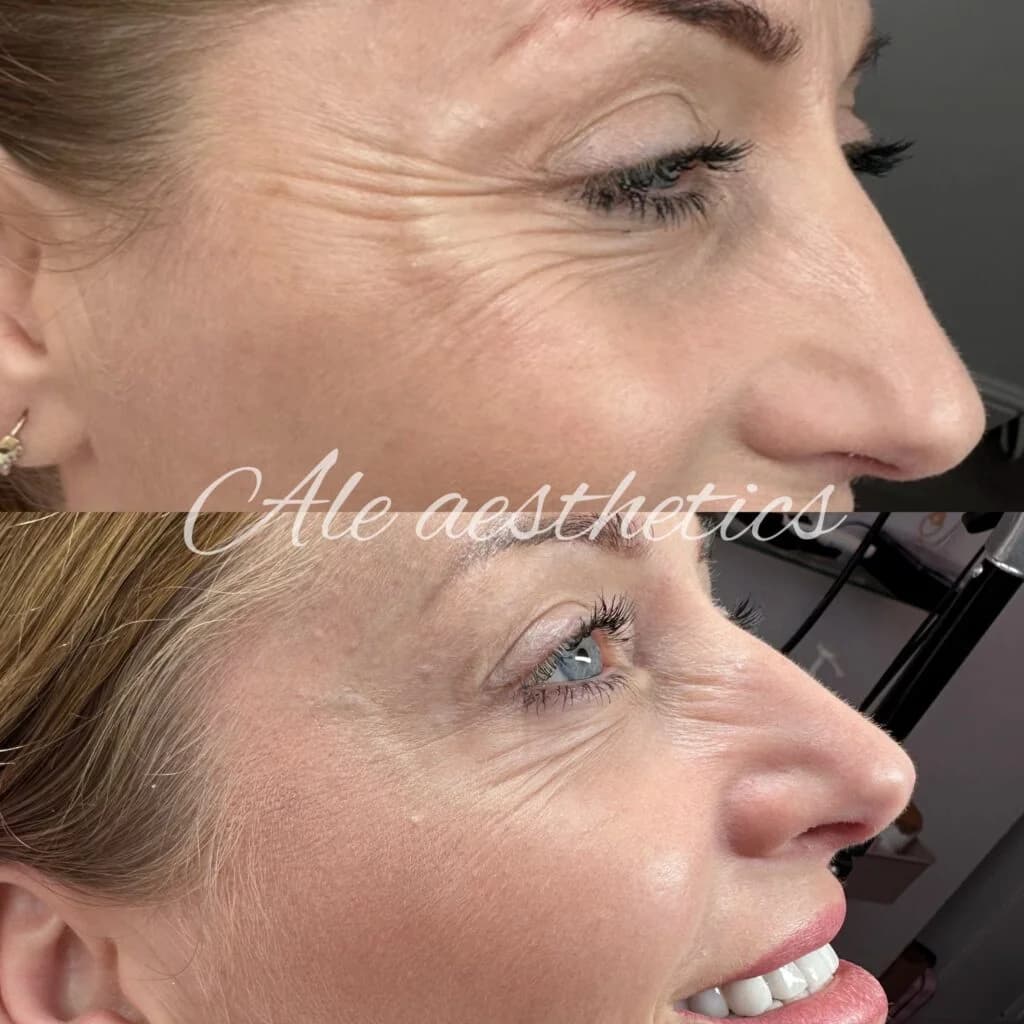 Botulinum Toxin before and after result