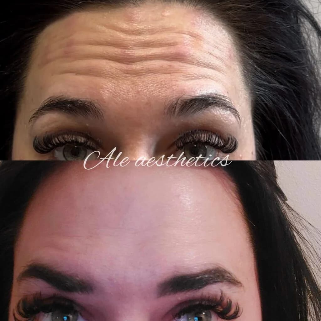 Botox — Forehead before and after result