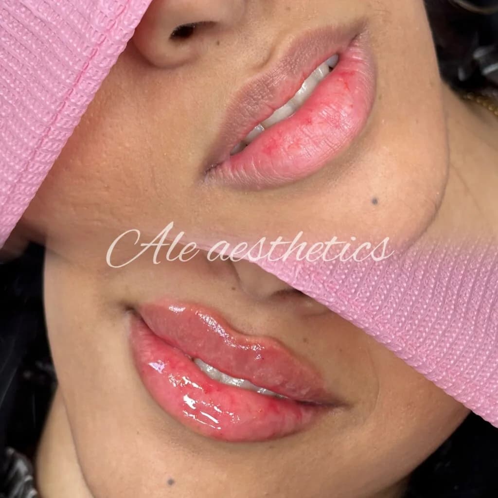 Lip Filler before and after result