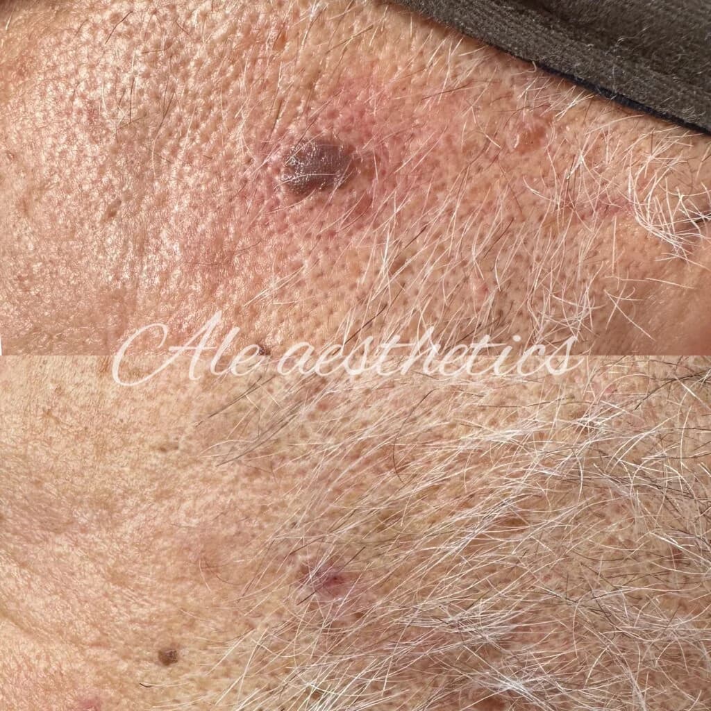 Skin Booster before and after result